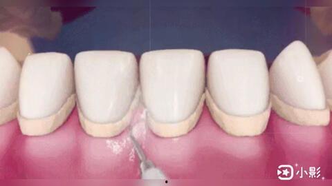 隐形牙套在线视频,在线视频带你轻松矫正牙齿之旅